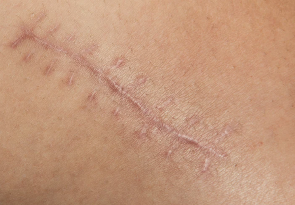 Sẹo lồi ngứa: Nguyên nhân, cơ chế và cách điều trị hiệu quả