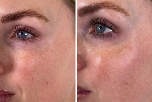 Skin Boosters là gì? Công dụng, sản phẩm và cách sử dụng hiệu quả