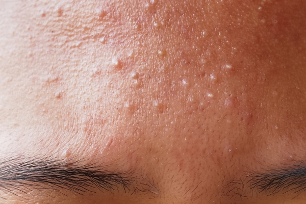 Thức khuya có gây mụn không? Nguyên nhân & cách cải thiện hiệu quả