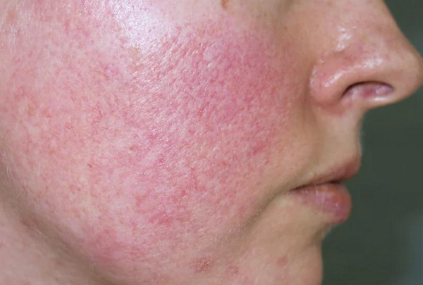 Thuốc trị giãn mao mạch ở mặt và những lưu ý an toàn