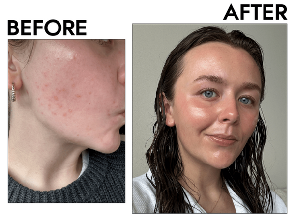 Trị mụn trứng cá bằng thuốc bôi nào tốt? Bác sĩ da liễu bật mí 5 hoạt chất hiệu quả nhất