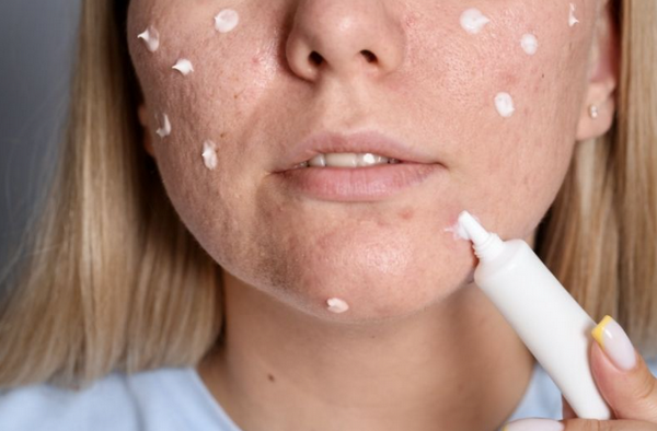 Trị mụn trứng cá bằng thuốc bôi nào tốt? Bác sĩ da liễu bật mí 5 hoạt chất hiệu quả nhất