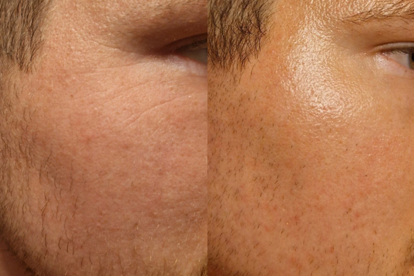 Trị mụn trứng cá bằng thuốc bôi nào tốt? Bác sĩ da liễu bật mí 5 hoạt chất hiệu quả nhất