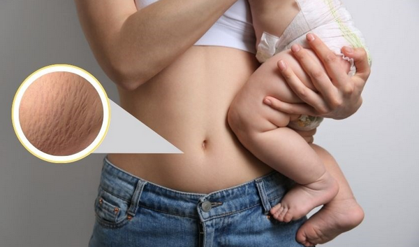 Trị rạn da mất bao lâu? Những yếu tố quyết định thời gian hồi phục