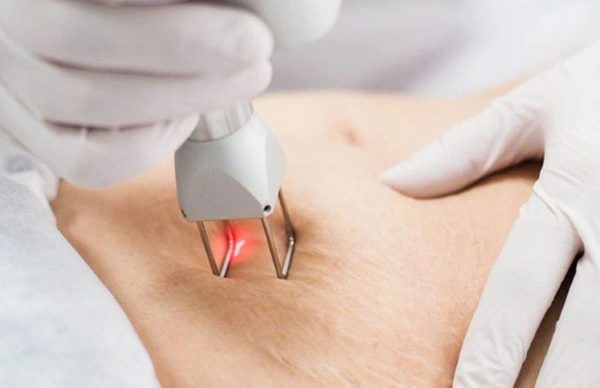 Trị rạn da mất bao lâu? Những yếu tố quyết định thời gian hồi phục