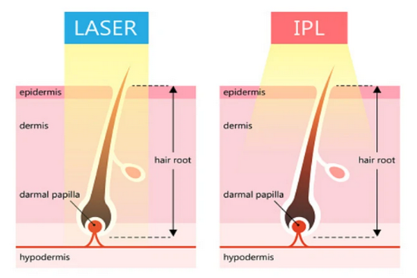 Triệt lông Diode laser và IPL cái nào tốt hơn? So sánh chi tiết từ A–Z