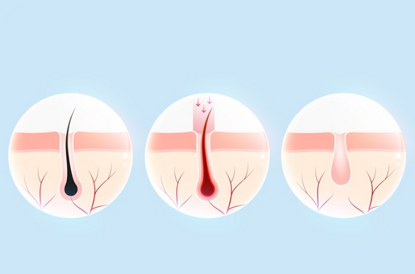 Triệt lông lạnh là gì? Công nghệ triệt lông hiện đại và an toàn