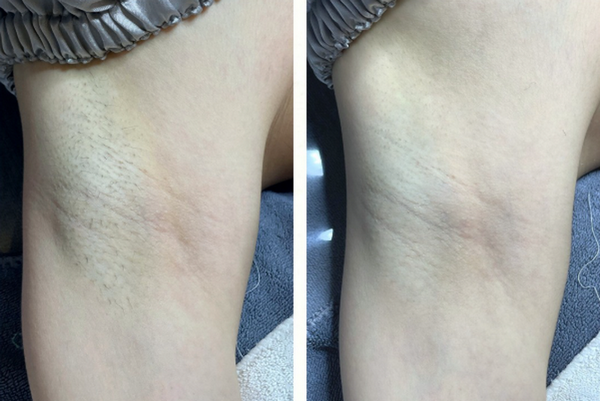 Triệt lông lạnh là gì? Công nghệ triệt lông hiện đại và an toàn