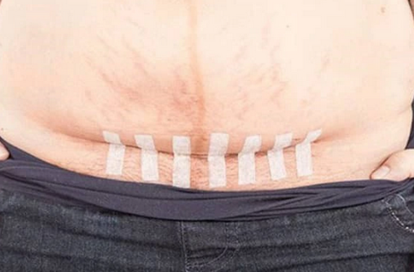 Vết mổ sau sinh bao lâu thì lành? Có để lại sẹo không