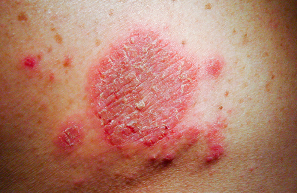 Viêm da cơ địa đồng xu: Nguyên nhân, dấu hiệu và cách điều trị