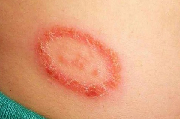 Viêm da cơ địa đồng xu: Nguyên nhân, dấu hiệu và cách điều trị