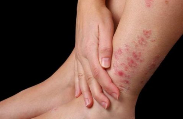 Viêm da cơ địa khô da, bong tróc và biện pháp khắc phục