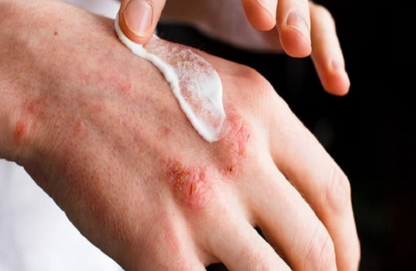 Viêm da cơ địa khô da, bong tróc và biện pháp khắc phục