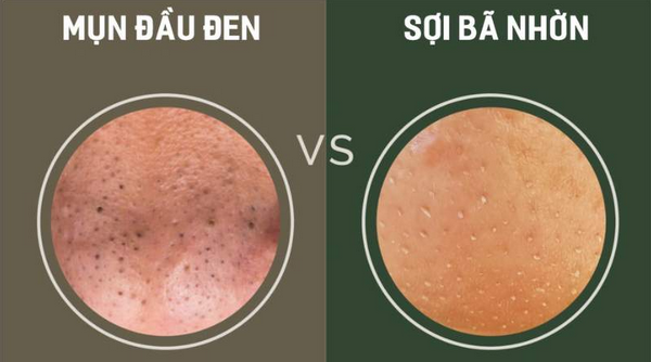 7 cách loại bỏ sợi bã nhờn ở mũi tại nhà: Đơn giản nhưng cực hiệu quả