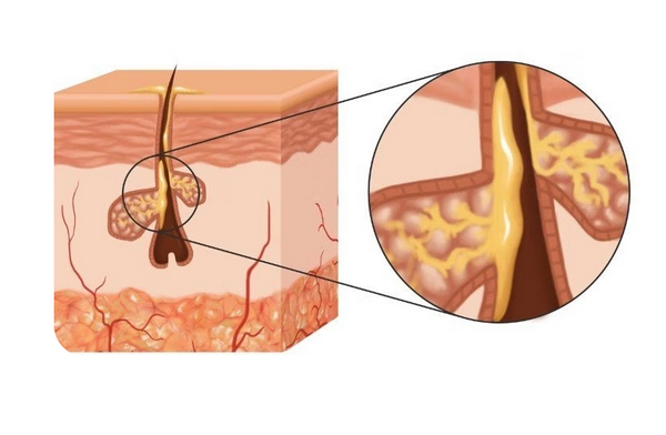 7 cách loại bỏ sợi bã nhờn ở mũi tại nhà: Đơn giản nhưng cực hiệu quả
