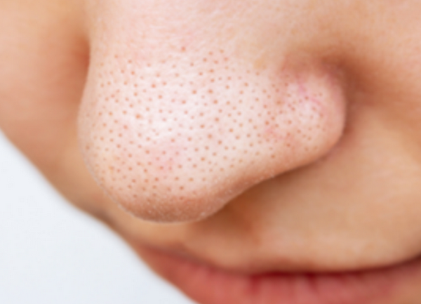 7 cách loại bỏ sợi bã nhờn ở mũi tại nhà: Đơn giản nhưng cực hiệu quả