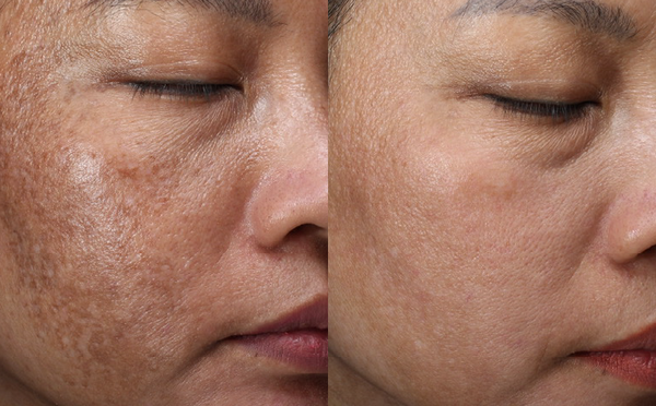 Nám da nên dùng hoạt chất gì? 7 hoạt chất trị nám được bác sĩ tin dùng