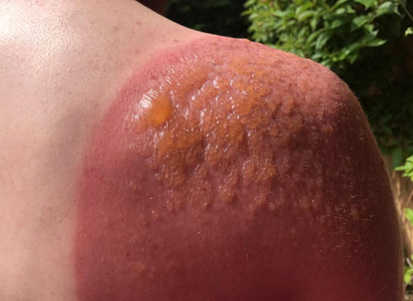 Bỏng nắng là gì? Có nguy hiểm không? Cách phục hồi da hiệu quả