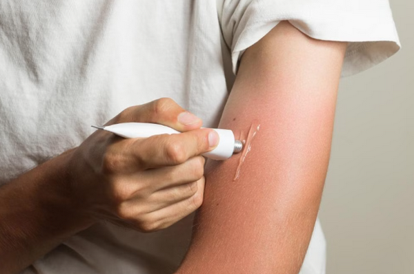 Bỏng nắng là gì? Có nguy hiểm không? Cách phục hồi da hiệu quả