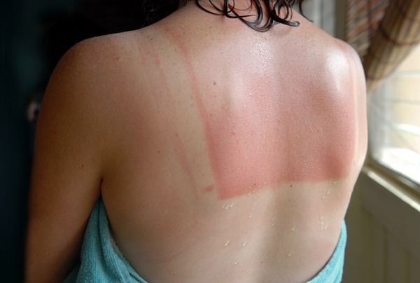 Bỏng nắng là gì? Có nguy hiểm không? Cách phục hồi da hiệu quả