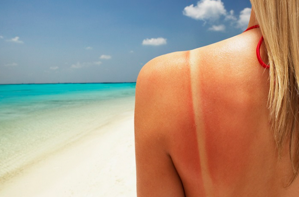 Cách phục hồi da sau khi đi nắng hiệu quả