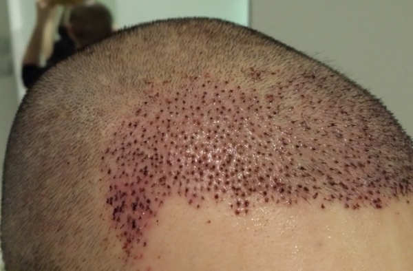 Cấy tóc có bị rụng lại không? Cách chăm sóc tóc sau cấy hiệu quả