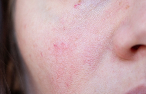 Da giãn mao mạch có nên dùng retinol không? Hướng dẫn an toàn cho da nhạy cảm