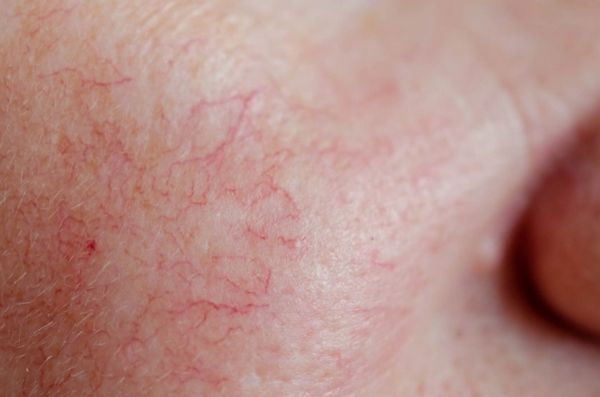 Da giãn mao mạch nên dùng gì và kiêng gì? Hướng dẫn chăm sóc đúng cách