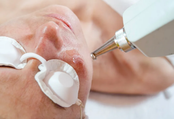 Da giãn mao mạch nên dùng gì và kiêng gì? Hướng dẫn chăm sóc đúng cách