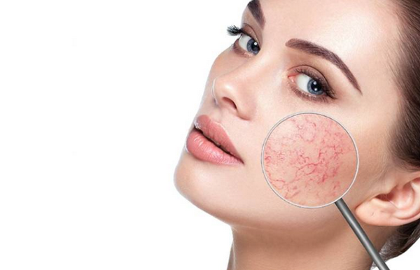 Da giãn mao mạch nên dùng gì và kiêng gì? Hướng dẫn chăm sóc đúng cách