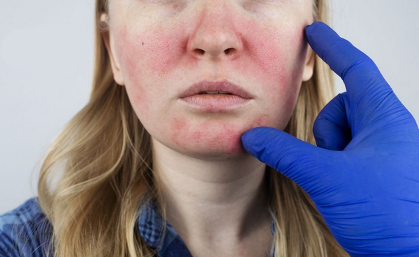 7 sai lầm khiến giãn mao mạch nặng hơn (ai cũng dễ mắc)