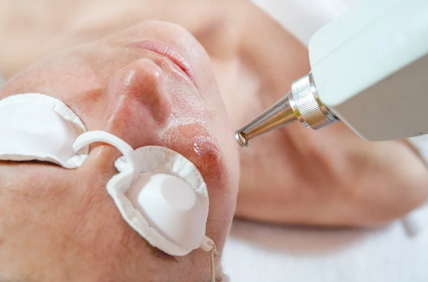 7 sai lầm khiến giãn mao mạch nặng hơn (ai cũng dễ mắc)