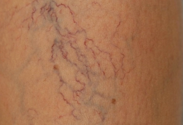 7 sai lầm khiến giãn mao mạch nặng hơn (ai cũng dễ mắc)