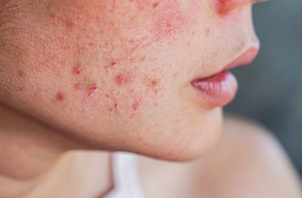 Mụn do đeo khẩu trang (Maskne): Nguyên nhân và cách xử lý hiệu quả