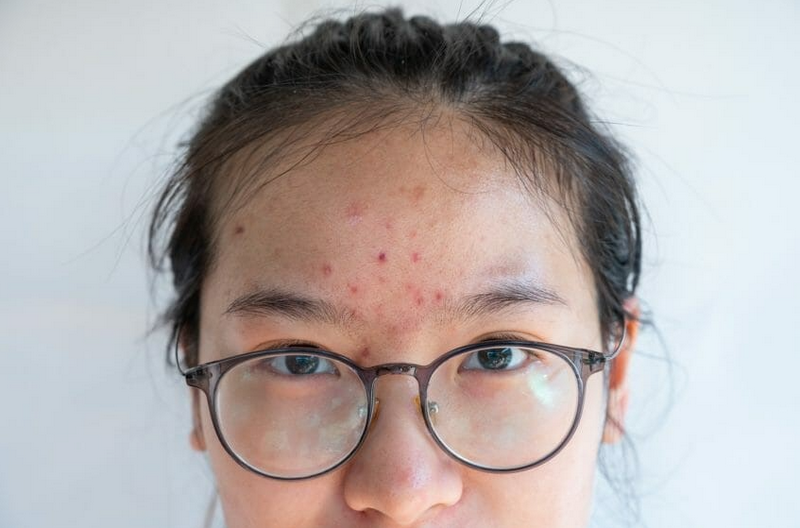 Mụn trứng cá do hormone: Nguyên nhân, dấu hiệu và cách điều trị hiệu quả