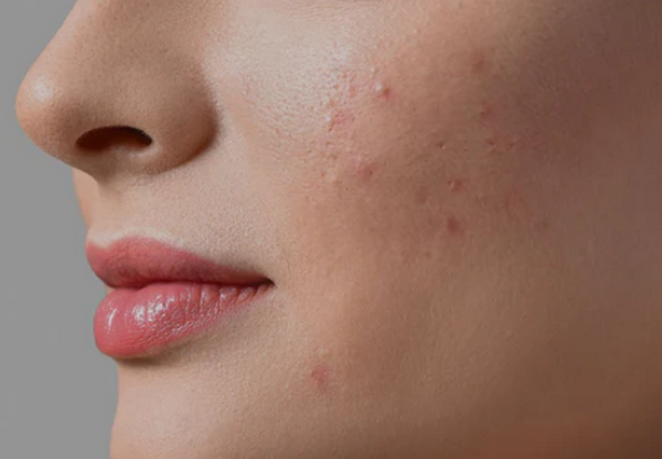 Mụn trứng cá do mỹ phẩm: 7 nguyên nhân & cách xử lý không tái phát