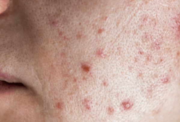 Mụn trứng cá do mỹ phẩm: 7 nguyên nhân & cách xử lý không tái phát