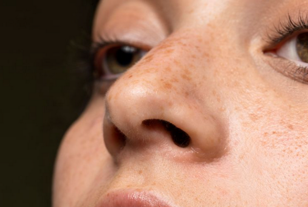 Nám Da Lâu Năm Có Tự Khỏi Không? Cách Điều Trị Hiệu Quả Nhất