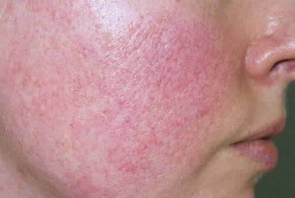 Peel da mùa hè có được không?