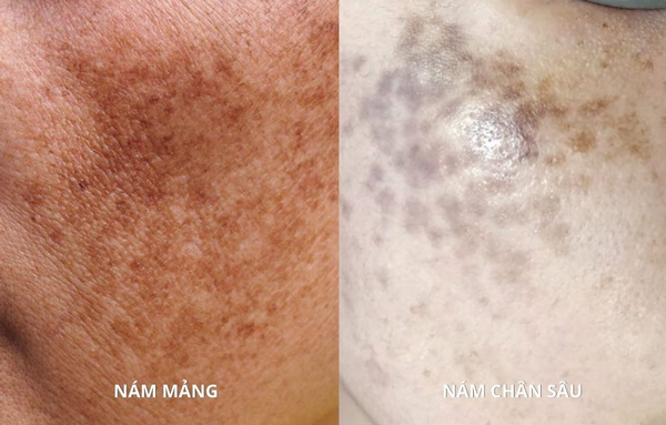 Phân biệt nám mảng, nám chân sâu và tàn nhang: Cách nhận biết chính xác nhất