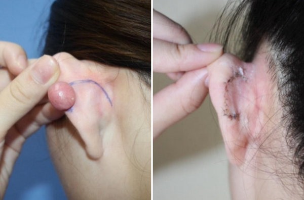 Phẫu thuật sẹo lồi: Có hiệu quả không? Chi phí bao nhiêu & có tái phát không?