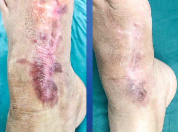 Phẫu thuật sẹo lồi: Có hiệu quả không? Chi phí bao nhiêu & có tái phát không?