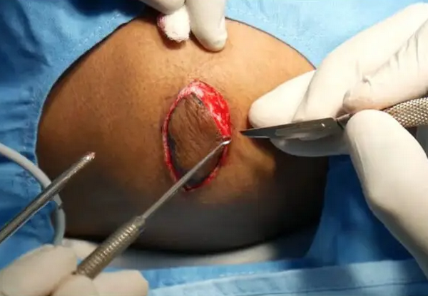 Phẫu thuật sẹo lồi: Có hiệu quả không? Chi phí bao nhiêu & có tái phát không?