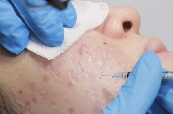 So sánh TCA CROSS vs subcision: Nên chọn phương pháp nào trị sẹo rỗ?