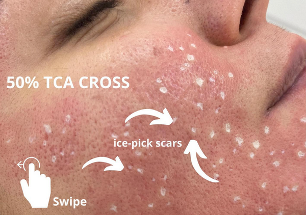 So sánh TCA CROSS vs subcision: Nên chọn phương pháp nào trị sẹo rỗ?