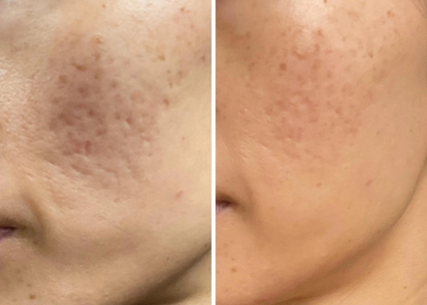 So sánh TCA CROSS vs subcision: Nên chọn phương pháp nào trị sẹo rỗ?