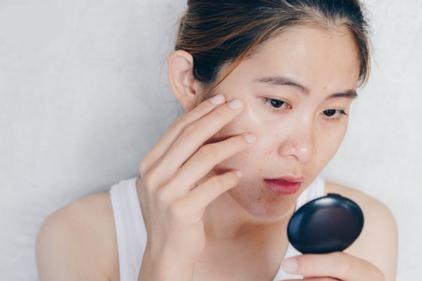Tại sao da vẫn nổi mụn dù chăm sóc kỹ? Chuyên gia giải đáp