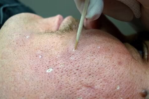 TCA có trị được sẹo rỗ lâu năm không? Hiệu quả thực tế ra sao?