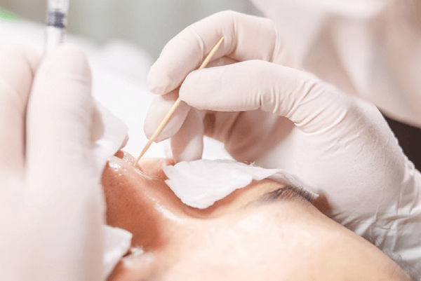 TCA có trị được sẹo rỗ lâu năm không? Hiệu quả thực tế ra sao?