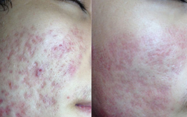 TCA có trị được sẹo rỗ lâu năm không? Hiệu quả thực tế ra sao?